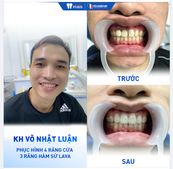XỬ LÝ RĂNG CỬA HỞ KẼ - XỈN MÀU, VIỀN CHÂN RĂNG ĐEN - KH VÕ NHẬT LUẬN