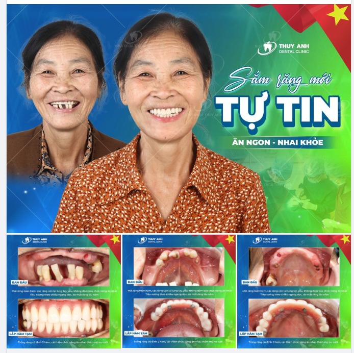 TRỒNG RĂNG TOÀN HÀM ĂN NGON, NHAI KHỎE, VUI VẺ TUỔI GIÀ