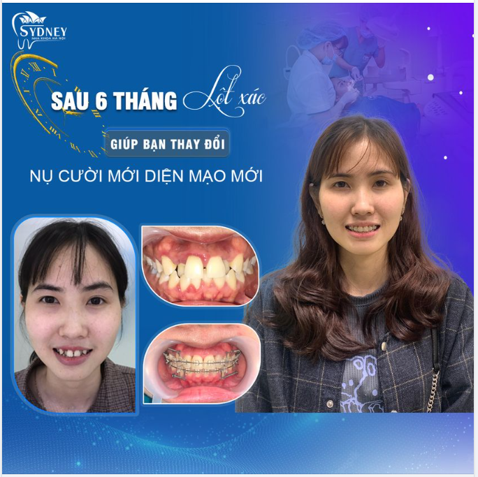 Khắc phục hàm răng khấp khểnh, khe thưa bằng chỉnh nha