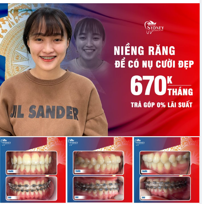 Có nên niềng răng hô?