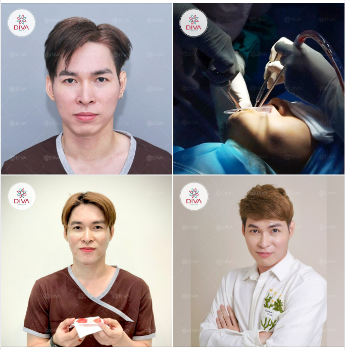 KẾT QUẢ THẨM MỸ SAU TIÊM MỠ CẰM - TÁCH TÚI MỠ MÁ TRONG GƯƠNG MẶT ĐẸP CÂN ĐỐI, HÀI HÒA
