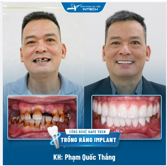 TRỒNG RĂNG IMPLANT – LẤY LẠI SỰ TỰ TIN ĂN NHAI
