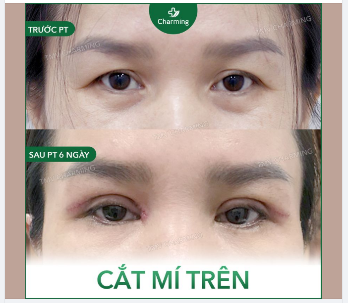 Tình trạng sụp mí là một trong những vấn đề làm nhiều người cảm thấy đau đầu và tự ti.