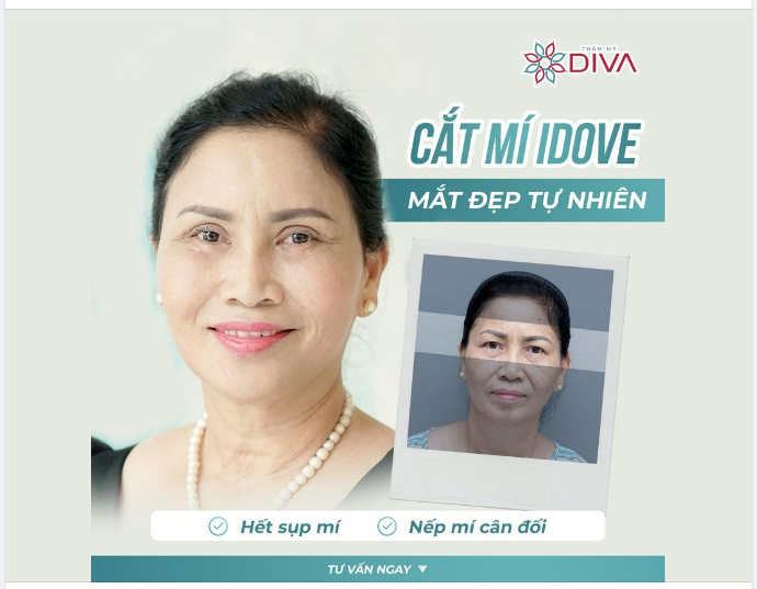 TẠM BIỆT MÍ SỤP, MẮT MỘT MÍ SAU CẮT MÍ MẮT