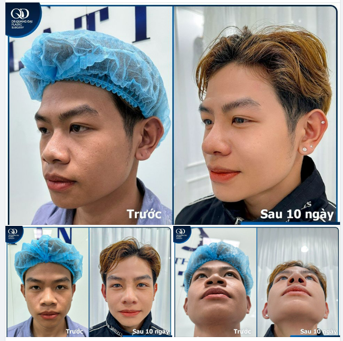 Chọn đi Nâng mũi trong chính ngày Sinh Nhật của mình và đây là cái kết