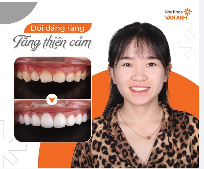 ĐỔI DÁNG RĂNG - TĂNG THIỆN CẢM