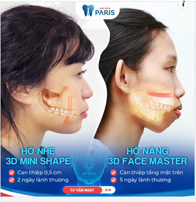 HÀM HÔ NHẸ - HÔ NẶNG: ĐÂU LÀ GIẢI PHÁP PHÙ HỢP VỚI BẠN?