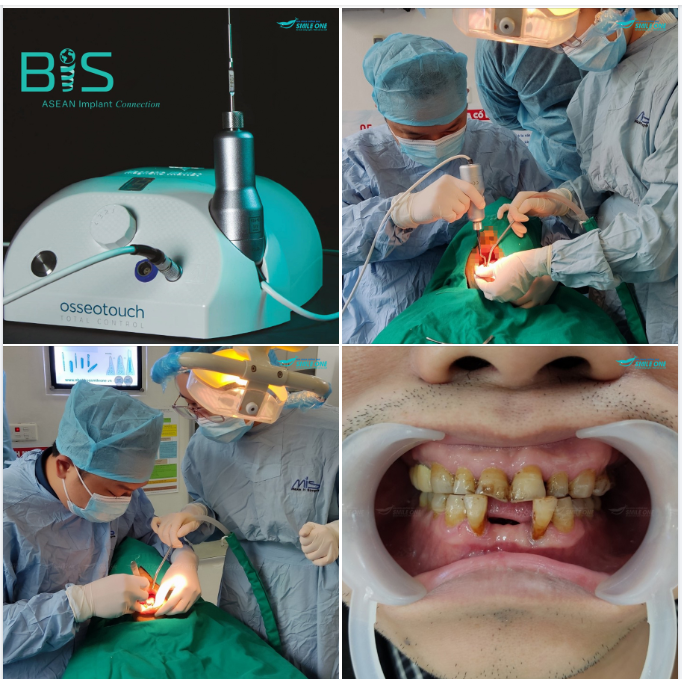 TRẢI NGHIỆM CÔNG NGHỆ TỪ TÍNH CỦA MAGNETIC MALLET TRONG CẤY GHÉP IMPLANT TẠI SMILE.