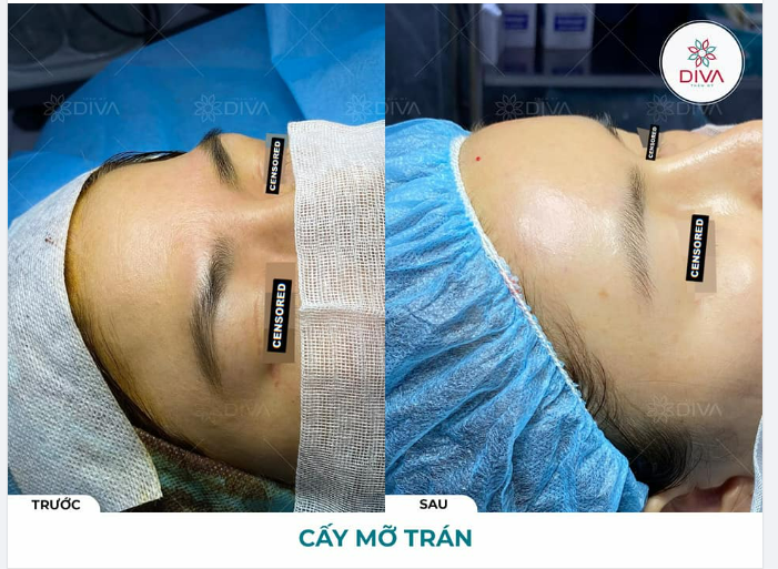 SAU TIÊM MỠ TRÁN CÓ ĐẸP NGAY KHÔNG?