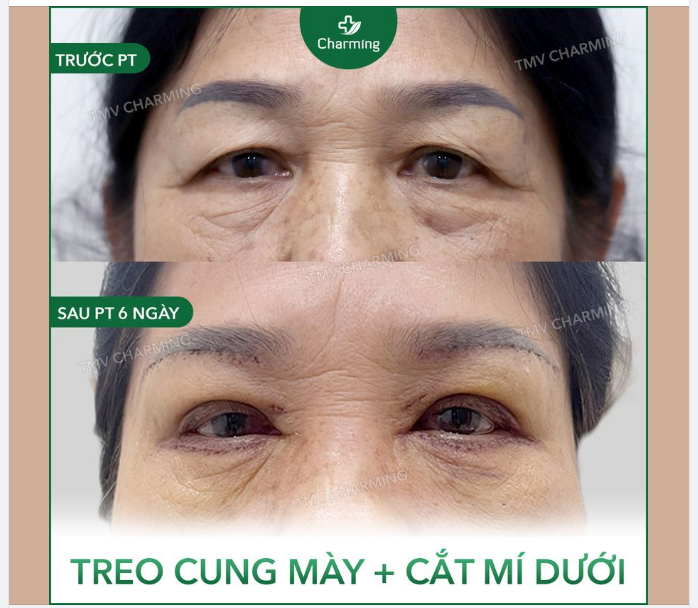 Khi còn trẻ, nếu mí đã đẹp sẵn, không mỡ thừa, thì khi lớn tuổi, có thêm một chút da chùng thôi thì bạn không cần đến phẫu thuật cắt mí trên đâu