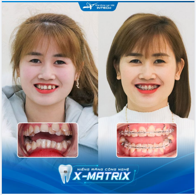 DÀN ĐỀU KHẤP KHỂNH CHỈ SAU 18 THÁNG VỚI CÔNG NGHỆ X-MATRIX