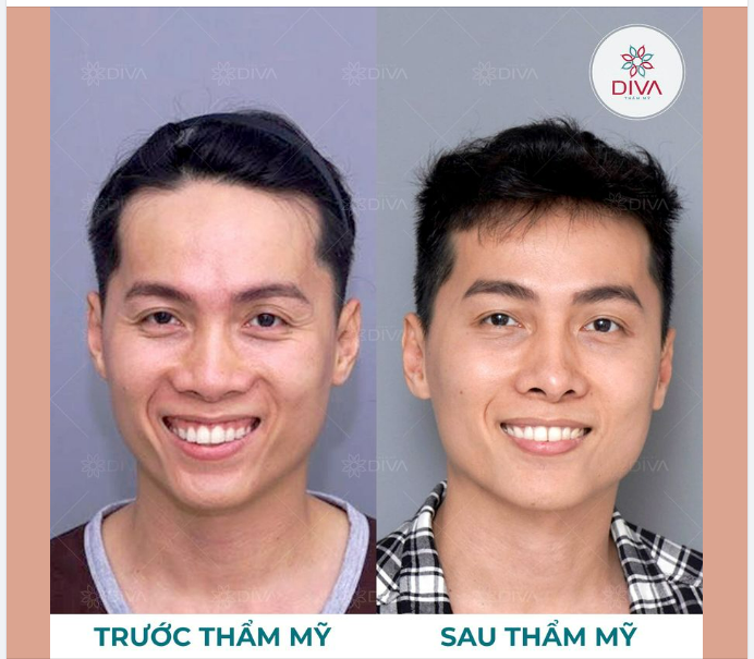 PHƯƠNG PHÁP THẨM MỸ NÀO GIÚP GƯƠNG MẶT TỪ HỐC HÁC, GẦY XƯƠNG TRỞ NÊN MỀM MẠI, CÂN ĐỐI NHƯ THẾ NÀY?