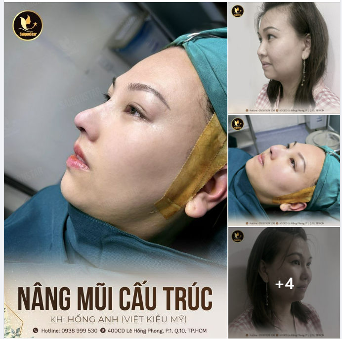 60 PHÚT NÂNG MŨI CẤU TRÚC