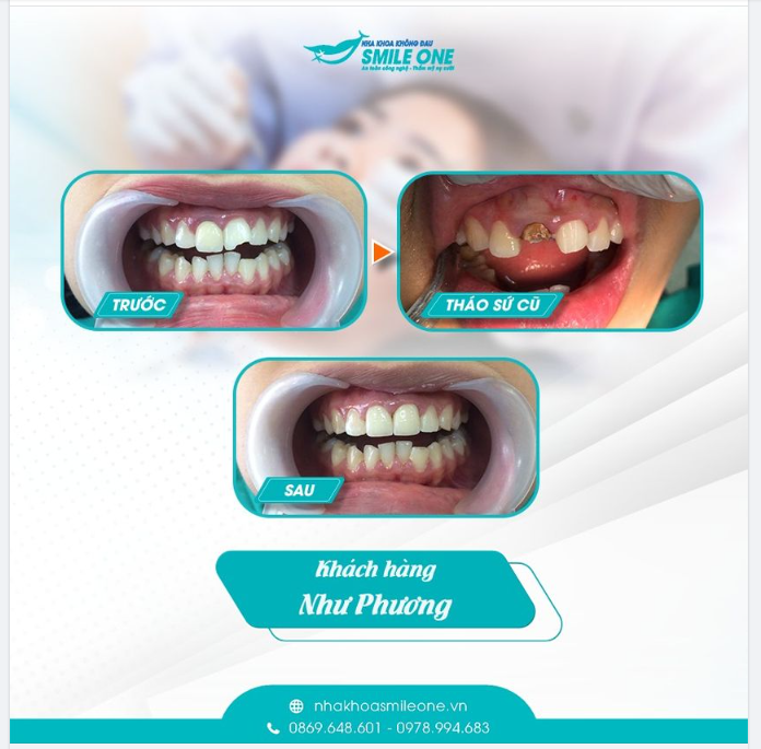 Các trường hợp cần bọc răng sứ