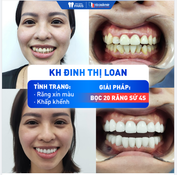 RĂNG XINH CƯỜI DUYÊN ĐÓN LỄ NHƯ KH ĐINH THỊ LOAN