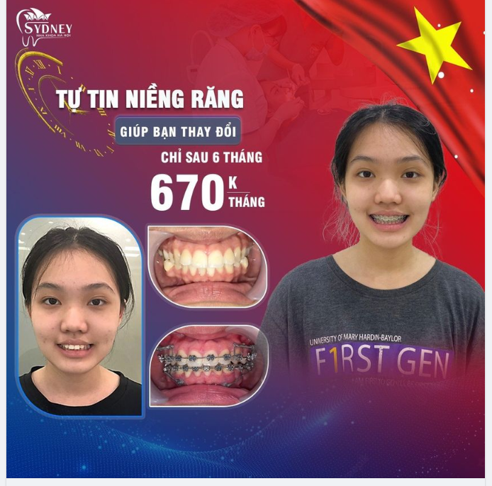 Niềng răng mắc cài kim loại trả góp 0%, chỉ 670k/ tháng