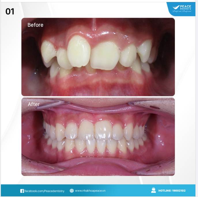Một ca niềng răng hiệu quả sẽ giúp khắc phục các khuyết điểm và hướng đến kết quả cuối cùng