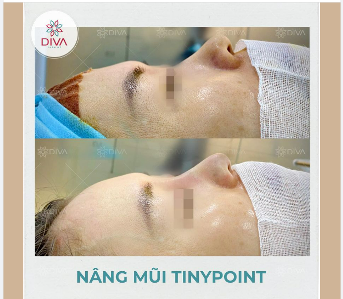 KẾT QUẢ THẨM MỸ MŨI CAO HÀI HÒA, TỰ NHIÊN SAU NÂNG MŨI TINY POINT