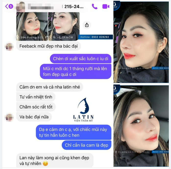 Dáng mũi vô form đẹp xuất sắc chỉ sau 1.5 tháng