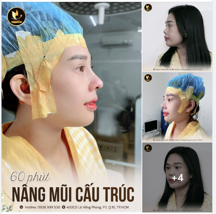 60 PHÚT NÂNG MŨI CẤU TRÚC