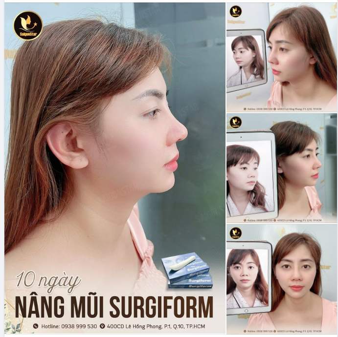 Khách hàng VIỆT KIỀU SINGAPORE chọn DÁNG MŨI thế nào?