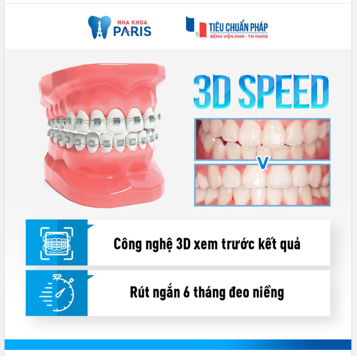 CÔNG NGHỆ 3D SPEED - RÚT NGẮN THỜI GIAN ĐEO NIỀNG 6 THÁNG