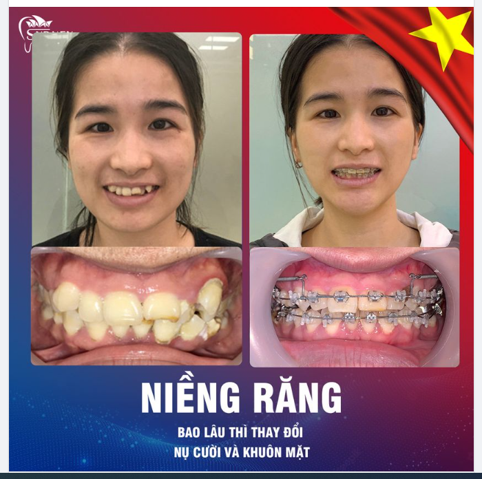 Niềng răng bao lâu nhận thấy sự thay đổi?