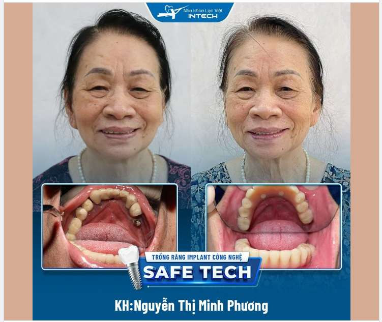 TRỒNG RĂNG IMPLANT ALL ON 4 – KHÔI PHỤC MẤT RĂNG TOÀN HÀM DƯỚI