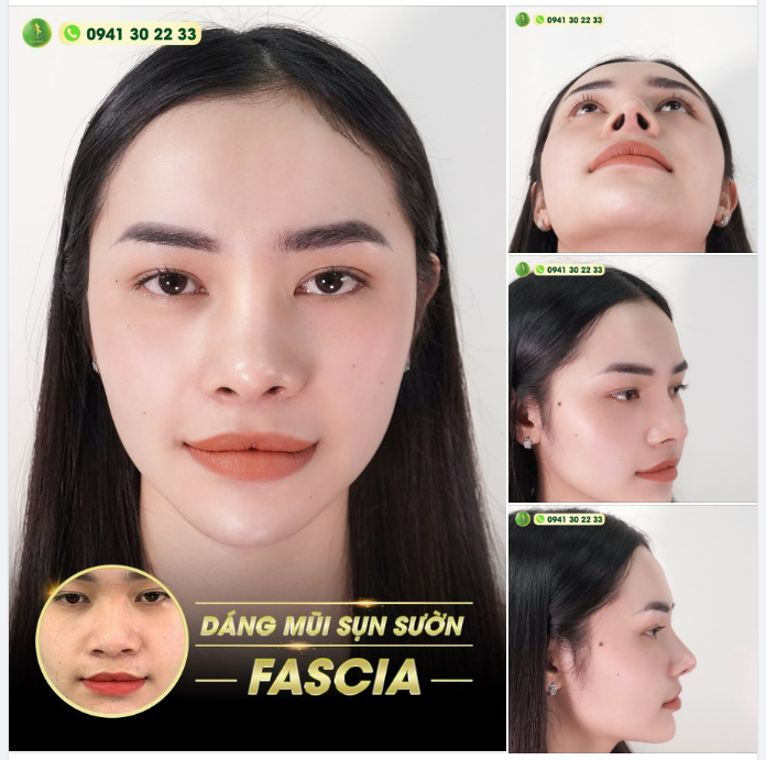 CẬN CẢNH CHIẾC MŨI SỤN SƯỜN ĐẸP KHÔNG GÓC CH.ẾT