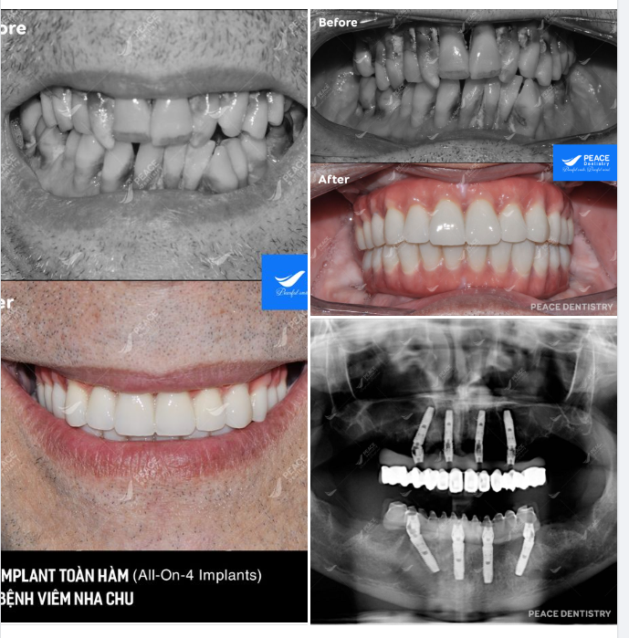 ALL-ON-4 IMPLANT CHO TRƯỜNG HỢP VIÊM NHA CHU NGHIÊM TRỌNG