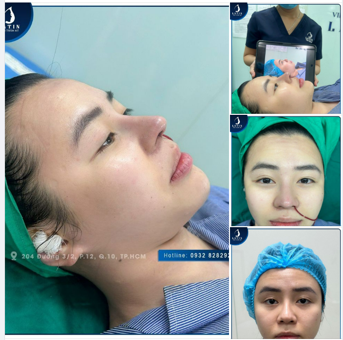 Chủ đề: SỬA MŨI HỎNG Ở NƠI KHÁC LÀM