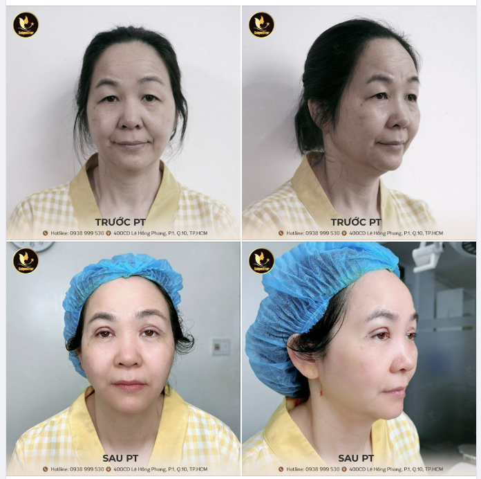 CẬN CẢNH KẾT QUẢ CA MÍ CHỈ SAU 30 PHÚT