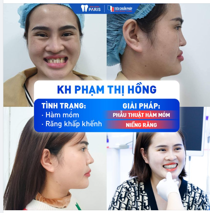 KH PHẠM THỊ HỒNG NHAN SẮC THĂNG HẠNG  PT HÀM MÓM + NIỀNG RĂNG