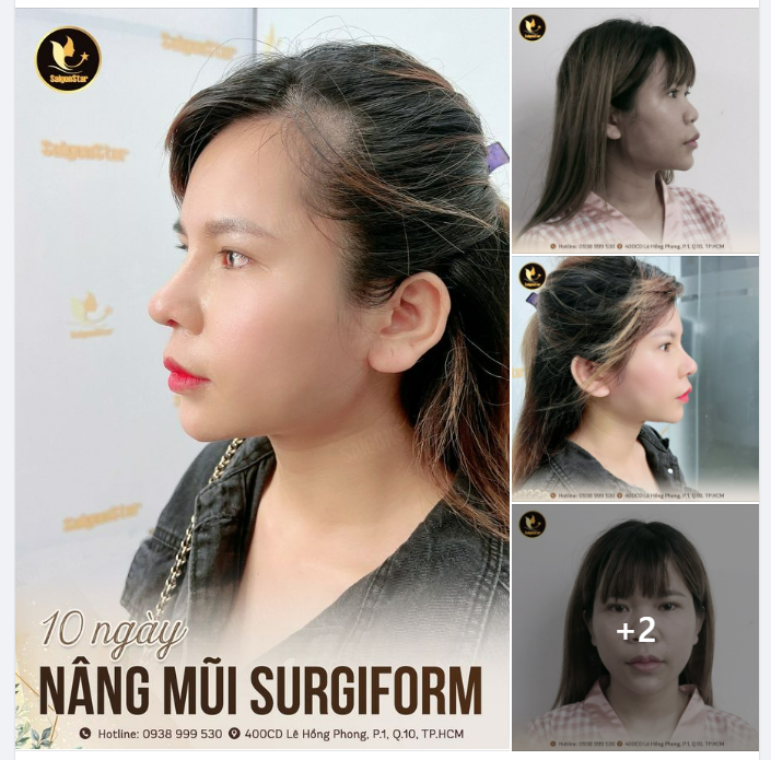 10 NGÀY NÂNG MŨI CẤU TRÚC SỤN SURGIFORM