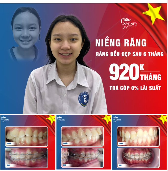 Răng cửa xoay trục chéo có khắc phục được không?
