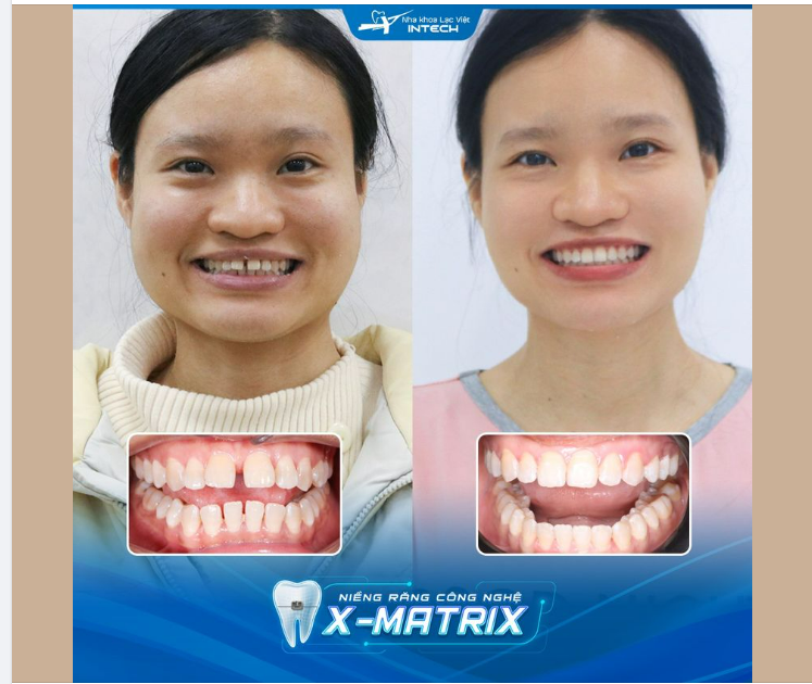 KHÔNG BAO GIỜ LÀ QUÁ MUỘN ĐỂ…. NIỀNG RĂNG