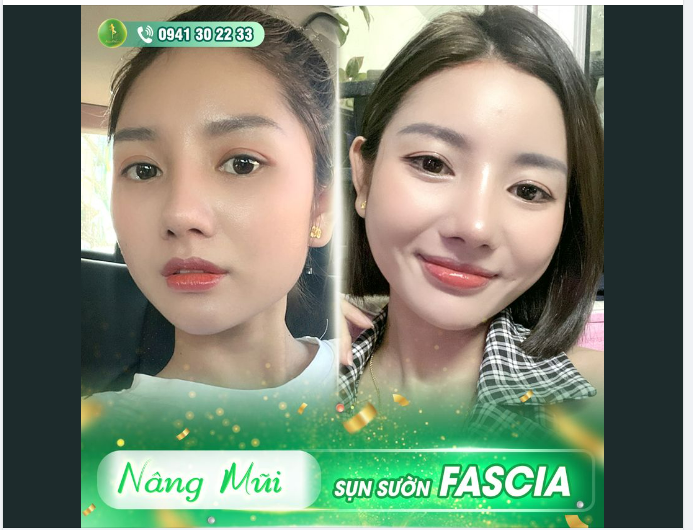 SỞ HỮU TỶ LỆ VÀNG BỀN VỮNG VỚI MŨI CẤU TRÚC SỤN SƯỜN