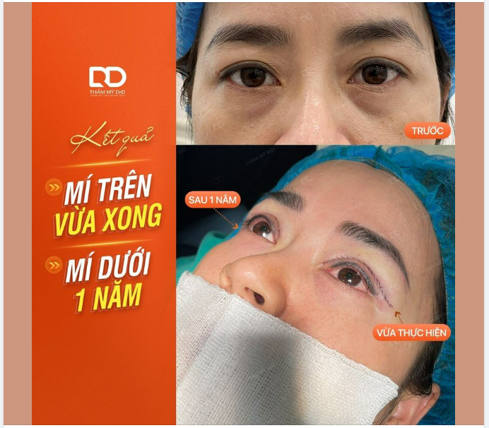 XOÁ "DẤU VẾT CỦA THỜI GIAN" VỚI COMBO CẮT MÍ TRÊN + DƯỚI