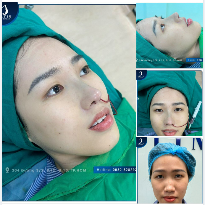 KẾT QUẢ NÂNG MŨI ĐÚNG NHƯ Ý MUỐN