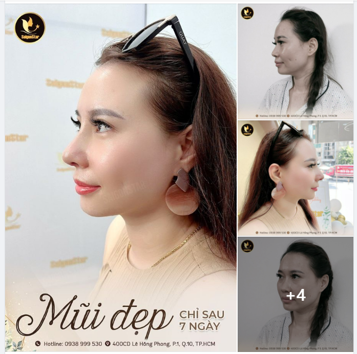 MŨI ĐẸP CHỈ SAU 7 NGÀY