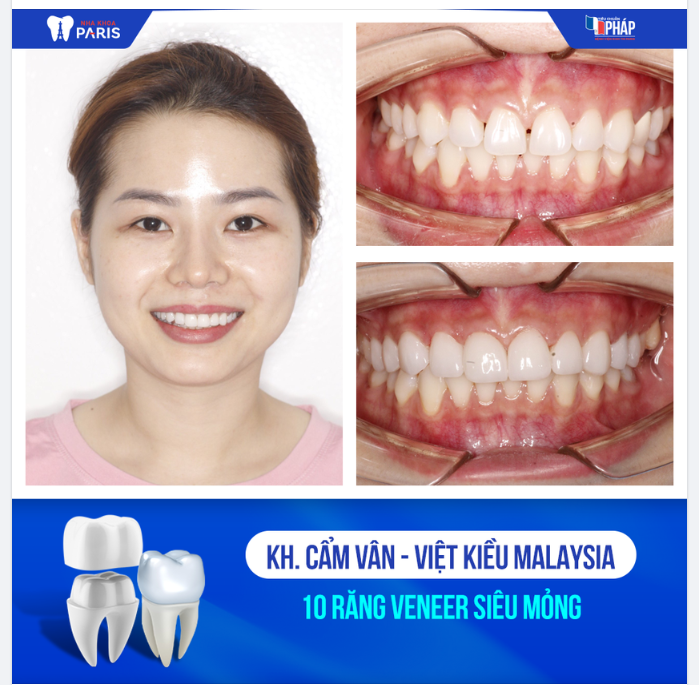 Dán sứ Veneer SIÊU MỎNG - KHÔNG MÀI NHỎ sẽ như thế nào?