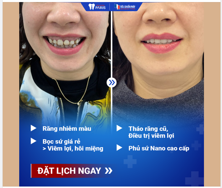 6tr/hàm răng sứ và TIỀN MẤT TẬT MANG: hô.i miệng, hỏ.ng răng, viê.m lợi