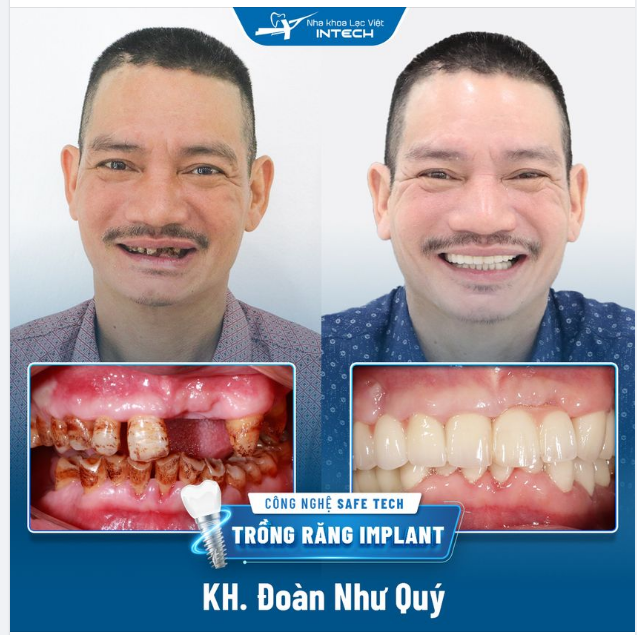 "CHÚ ĐI TỪ HẢI DƯƠNG LÊN NHA KHOA LẠC VIỆT INTECH MỚI LÀM ĐƯỢC BỘ RĂNG ƯNG Ý"