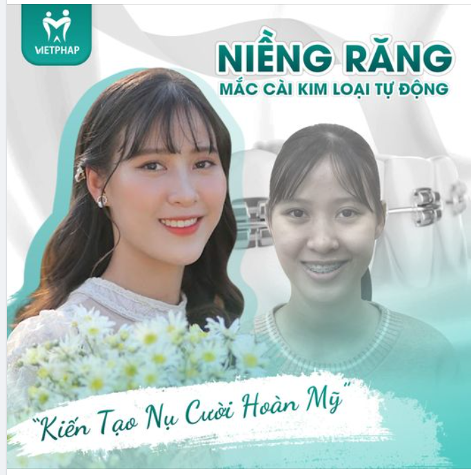 NIỀNG RĂNG MẮC CÀI KIM LOẠI TỰ ĐỘNG – KIẾN TẠO NỤ CƯỜI HOÀN MỸ