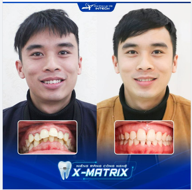 TẠM BIỆT RĂNG HÔ - KHỚP CẮN SÂU NHỜ NIỀNG RĂNG CÔNG NGHỆ X-MATRIX