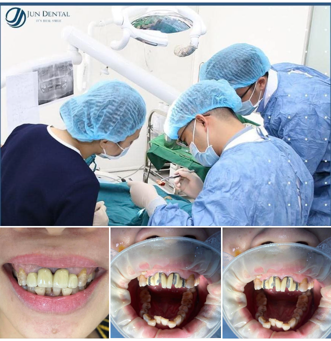 ĐỔI RĂNG KIM LOẠI LẤY RĂNG SỨ HOÀN TOÀN