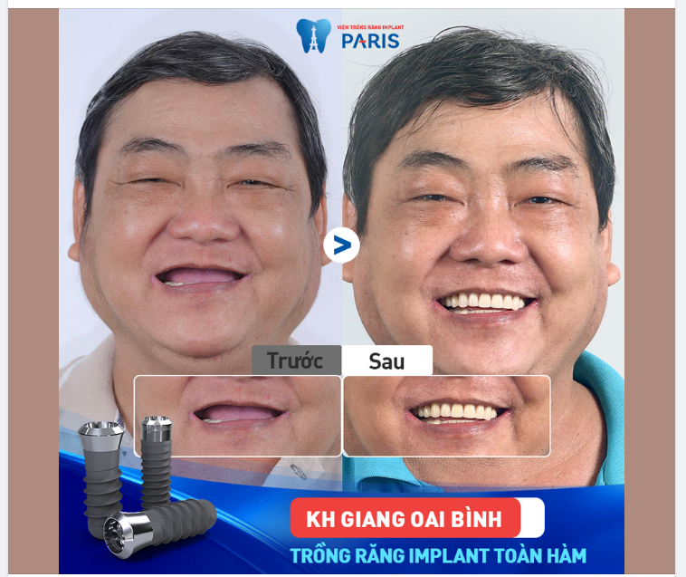 KHÔI PHỤC RĂNG TOÀN HÀM ĂN NHAI BỀN CHẮC