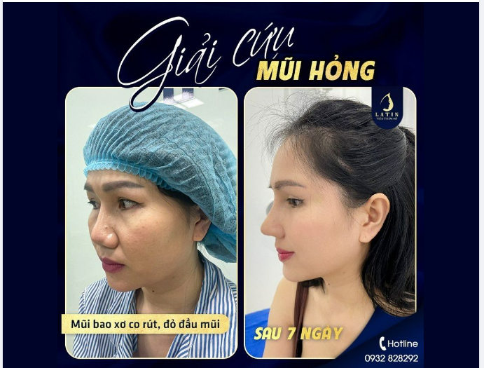 GIẢI CỨU MŨI HỎNG THÀNH CÔNG cho chị khách hàng Việt kiều Mỹ