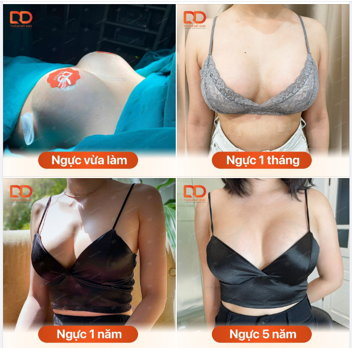 NÂNG NGỰC 1 THỜI GIAN CÓ BỊ NHỎ LẠI HAY KHÔNG?