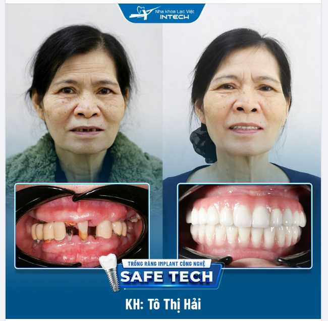 TRỒNG RĂNG TOÀN 2 HÀM ALL-ON-4 - ĂN NHAI HOÀN HẢO, VUI HƯỞNG TUỔI GIÀ